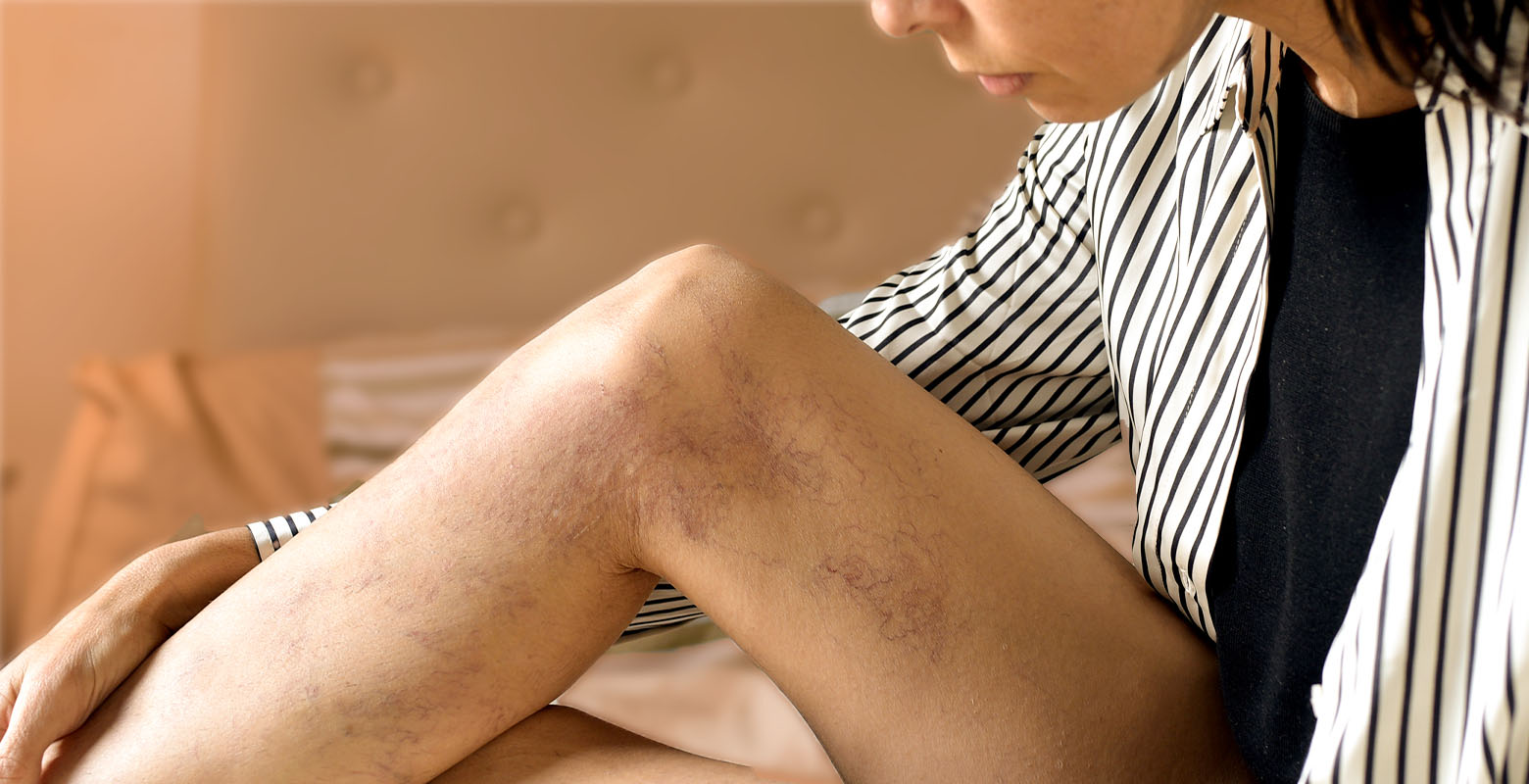 Guia RaÌpido Varizes: Causas, Sintomas e OpçoÌes De Tratamento